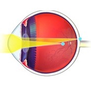 Αστιγματισμός