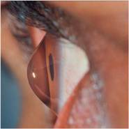 Κερατόκωνος