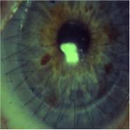 Μεταμόσχευση Κερατοειδούς